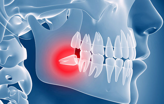 Denti del giudizio: i consigli dal tuo dentista in Brianza